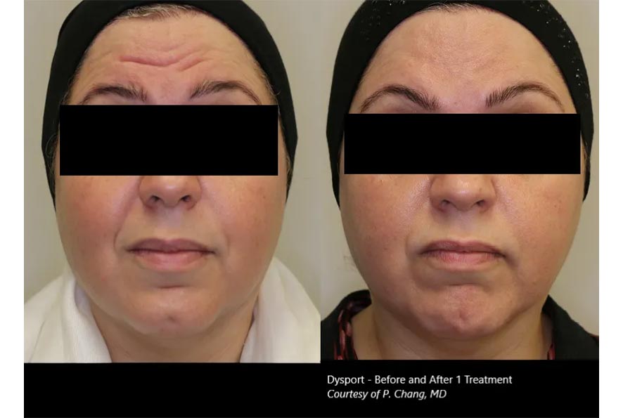 Botox-Before-&-After-2