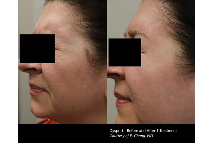 Botox-Before-&-After-3