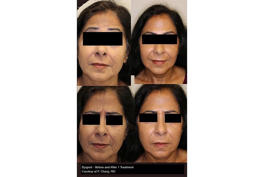 Botox-Before-&-After-4