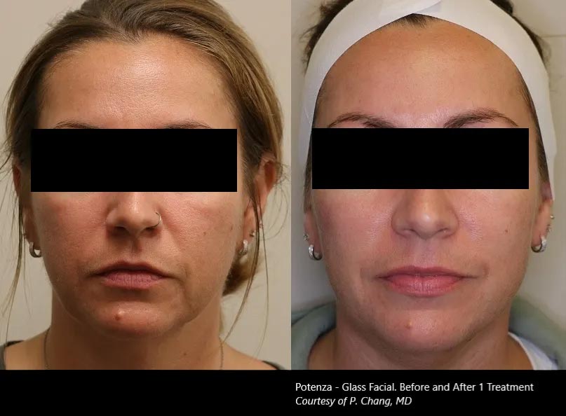 Microneedling-BF-2