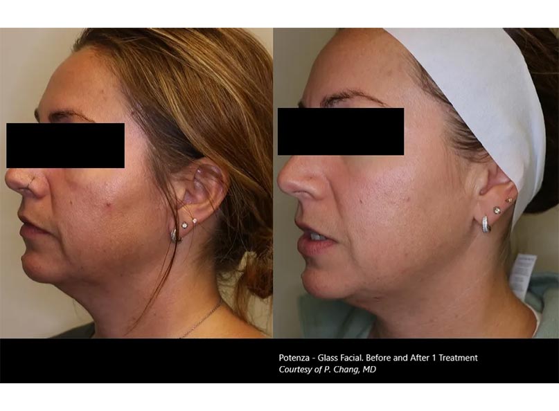 Microneedling-BF-3