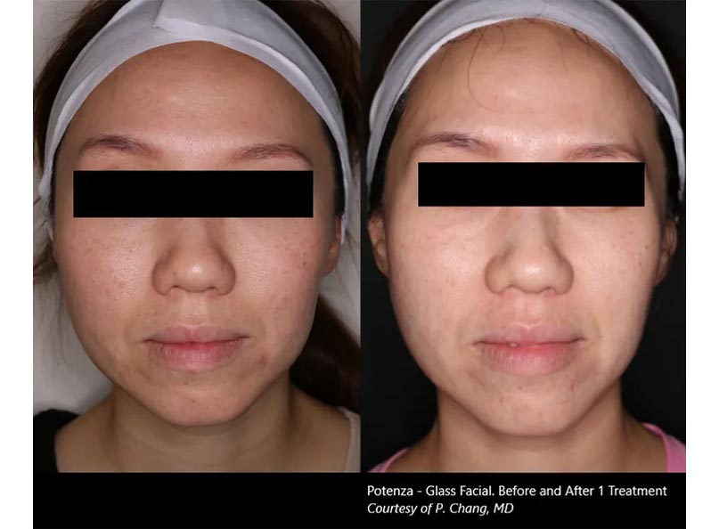 Microneedling-BF-5